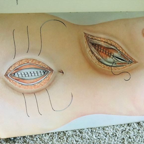 Vintage Medical Ephemera -Ethicon The Abdomen- Layers of Abdomen - Stitches 1968 - Picture 12 of 14